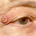 кератоакантома у человека на глазу