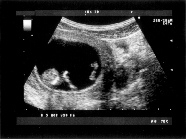 Фото плода на 10 неделю беременностимальчиком
