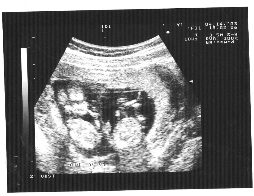 Двойня на фото плода на 10 неделю беременности
