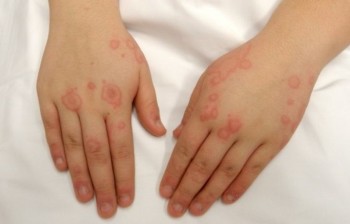 Проявление дерматита на коже рук