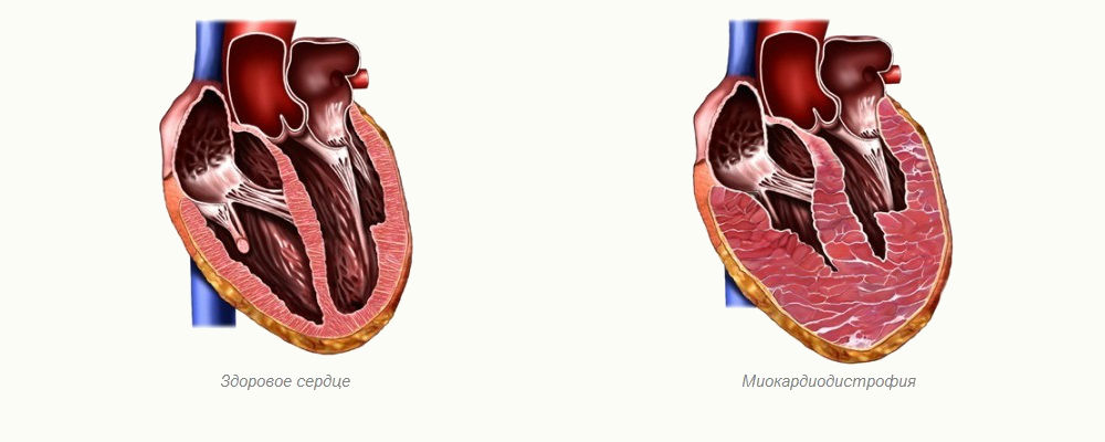 Миокардиодистрофия – поражение сердечной мышцы невоспалительного характера, характеризующееся нарушением ее метаболизма, возникновением дистрофических процессов в результате влияния различных факторов.