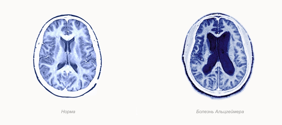 Болезнь Альцгеймера – неизлечимое дегенеративное поражение центральной нервной системы, при котором постепенно ухудшаются и теряются память, речь, логика, наблюдается расстройство интеллекта. 