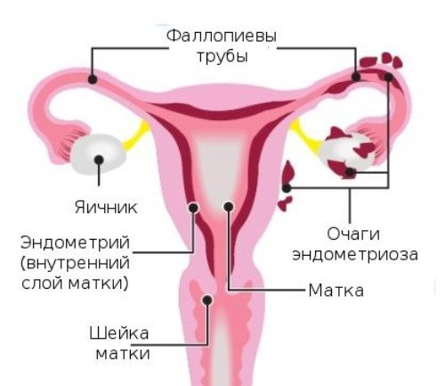 Описание: http://www.vse-pro-detey.ru/wp-content/uploads/2015/05/endometrioz.jpg