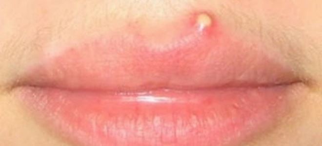 Прыщ на губе – в чем причина неприятности и как ее устранить?