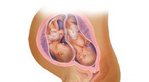 Беременность двойней на 27 неделе у женщины