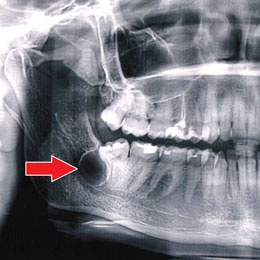 Киста зуба фото 1