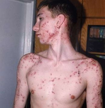 Угревая сыпь фото 0