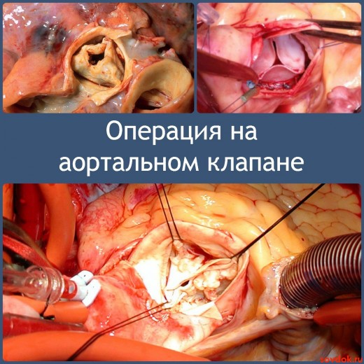 Операция на аортальном клапане
