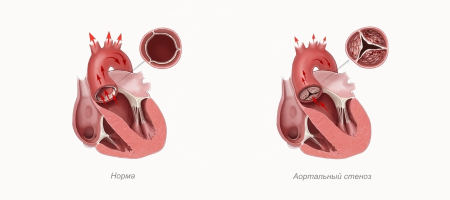 Аортальный стеноз – заболевание, при котором происходит сужение выходного отверстия аортального клапана, что приводит к ограничению поступления крови из левого желудочка в сторону аорты.