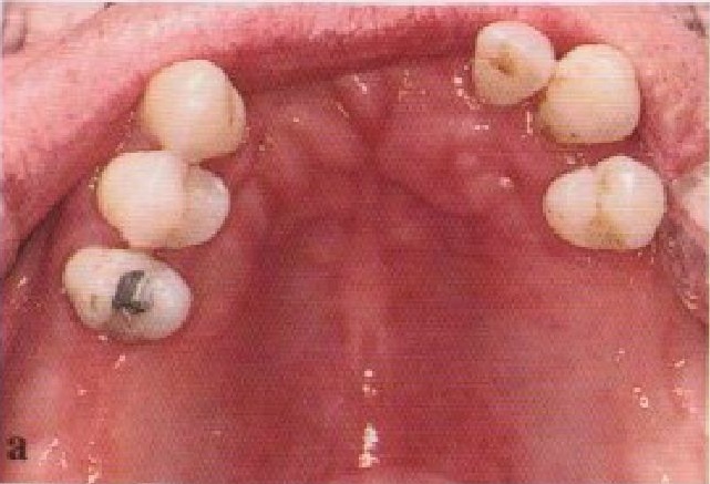Дефекты зубных рядов фото 3