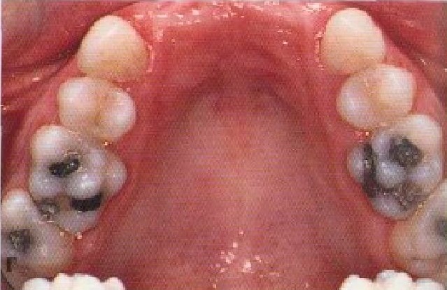 Дефекты зубных рядов фото 0