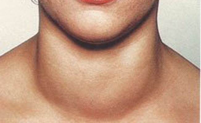 Зоб диффузный фото 0
