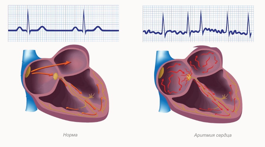 Аритмия сердца – это нарушение ритма сердечных сокращений.