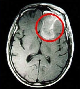Рак головного мозга фото 5