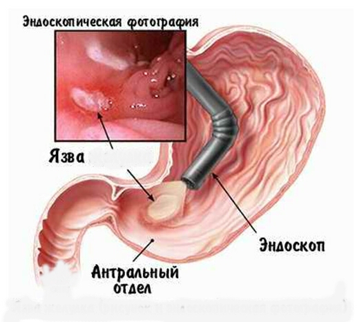 Эндоскопическая фотография