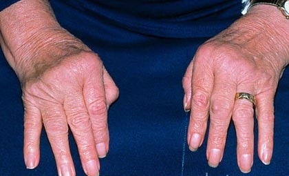 Ревматоидный артрит фото 2