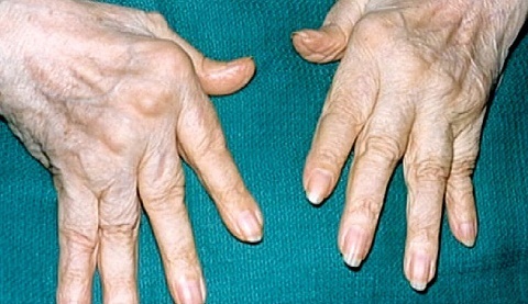 Ревматоидный артрит фото 1