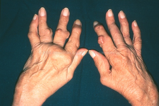 Ревматоидный артрит фото 0