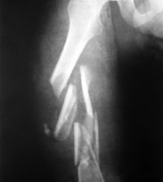 Переломы костей фото 5