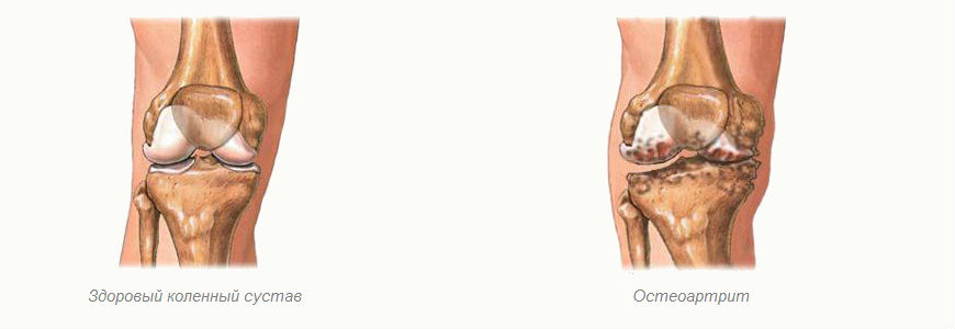 Остеоартрит – это заболевание костей, которое развивается медленно, с плохо выраженными симптомами, не вызывает серьезную потерю работоспособности, поражает кисти рук, коленные суставы и кости позвоночника.