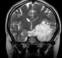 Астроцитома головного мозга фото 2