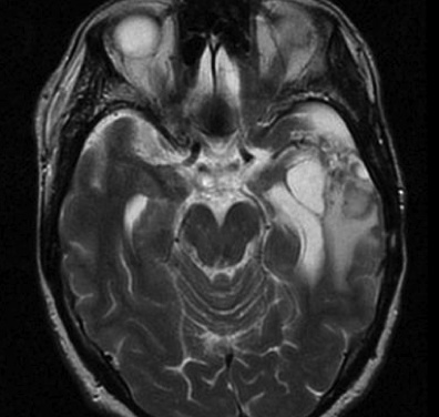 Астроцитома головного мозга фото 1