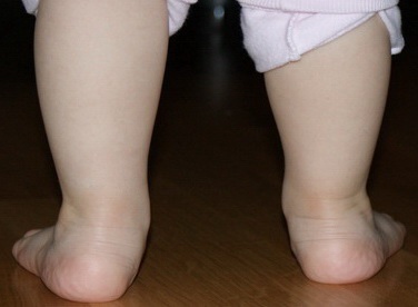 Вальгусная деформация стопы у детей фото 3