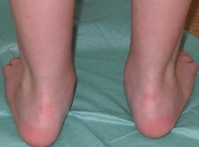 Вальгусная деформация стопы у детей фото 2