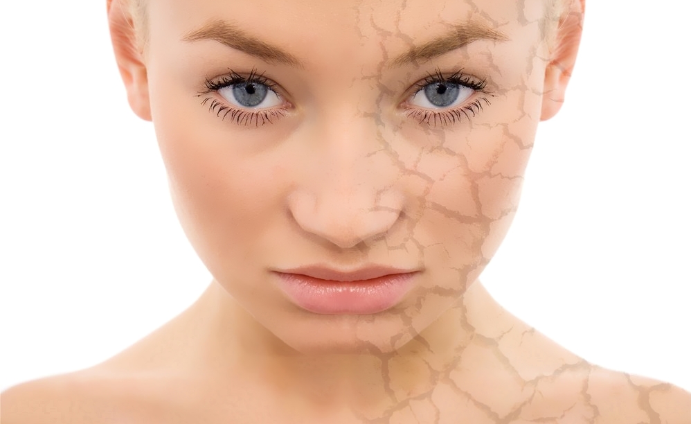 Фотостарение кожи (преждевременное старение кожи, актинический дерматоз, гелиодерматит) – состояние кожи, при котором развиваются гистологические, функциональные и клинические признаки старения, вызванные длительным влиянием солнечных лучей.
