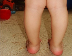 Вальгусная деформация стопы у детей фото 1