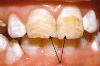 Гипоплазия эмали фото 0
