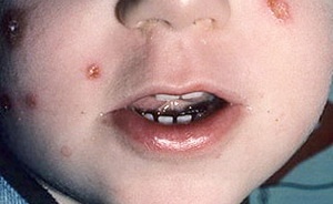 Стрептодермия у детей фото 1