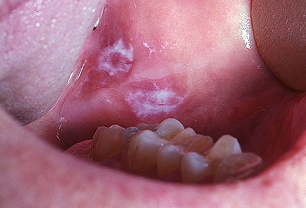 Лейкоплакия полости рта фото 0