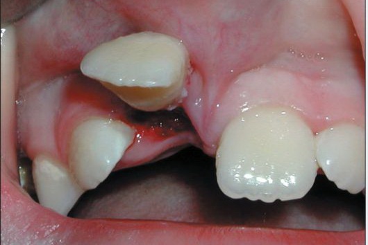 Вывих зуба фото 2