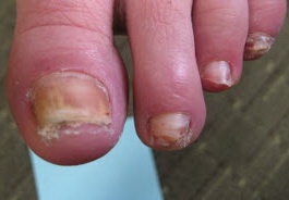 Эпидермофития ногтей (ЭН) фото 2