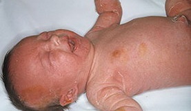 Эпидемическая пузырчатка новорожденных (ЭПН) фото 1
