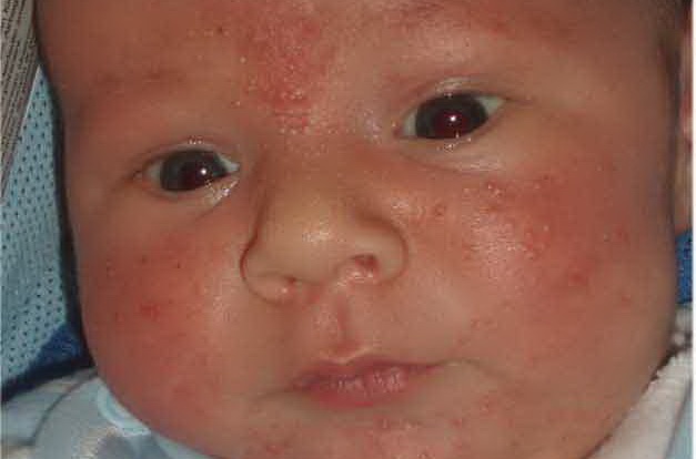 Эпидемическая пузырчатка новорожденных (ЭПН) фото 0