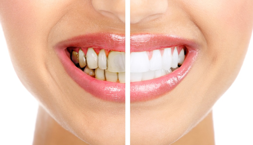 Зубной камень возникает в результате отложения на поверхности зубов затвердевшего зубного налета. 