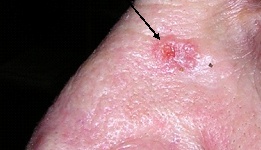 Рак кожи (РК) фото 1