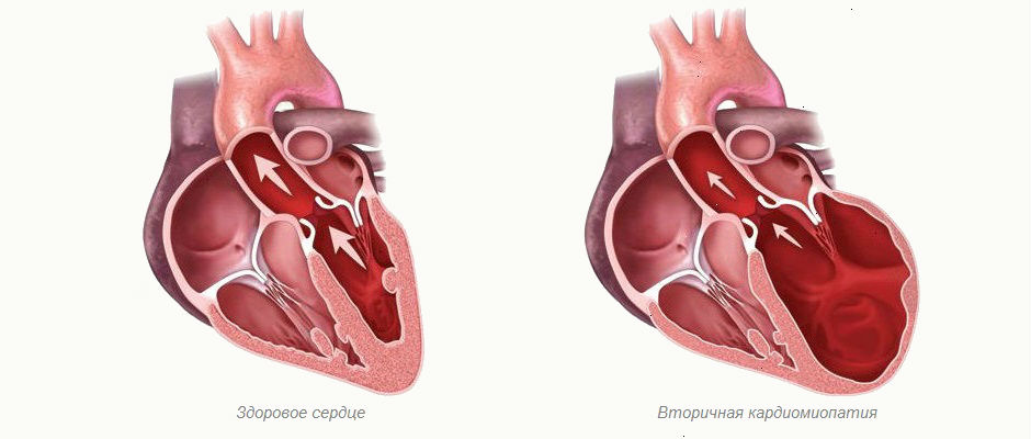 Вторичная кардиомиопатия – изменения структурного и функционального порядка в тканях сердца, возникновение которых обусловлено действием первичных заболеваний различной природы или патологических состояний.
