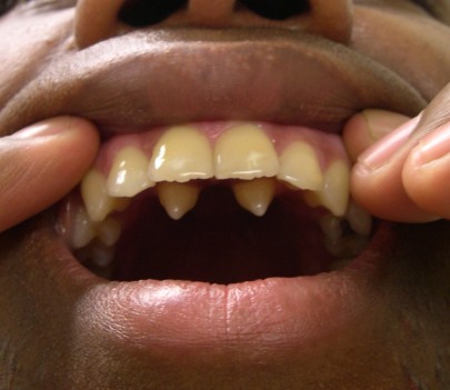 Лишние зубы