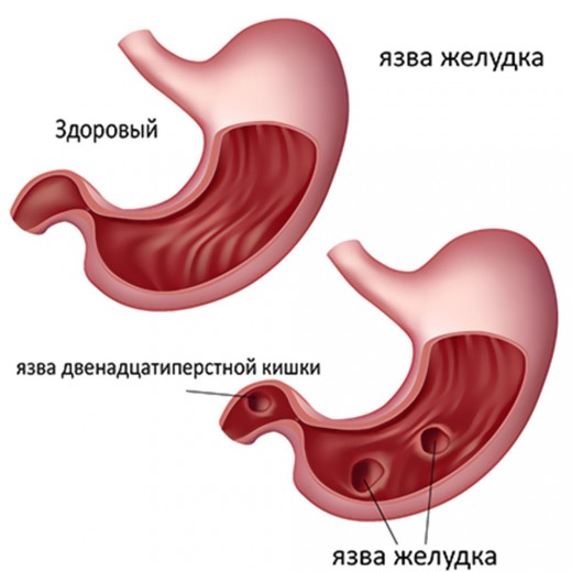 атрофия слизистой желудка