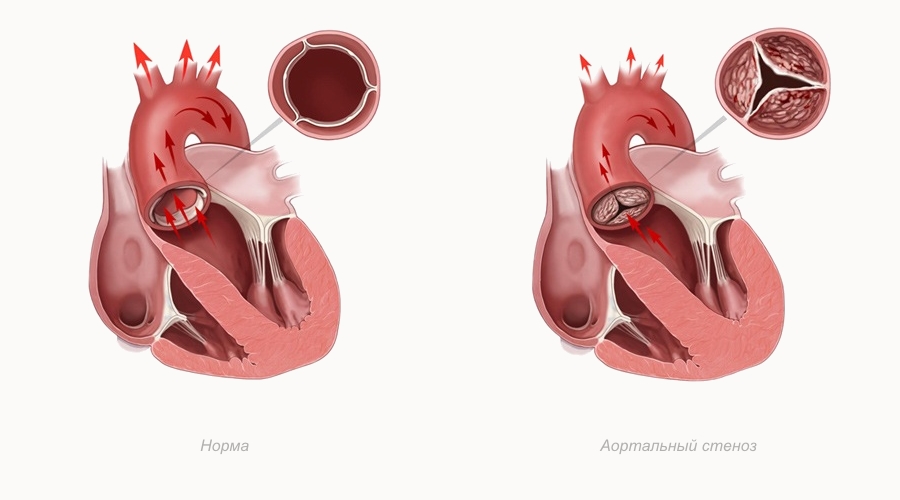 Врожденный порок сердца – это врожденный анатомический дефект сердца, его клапанов или сосудов.