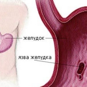 Особенности диеты при язве желудка
