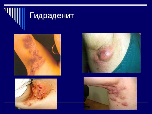 97 2 600x450 Проявления и лечение гидраденита