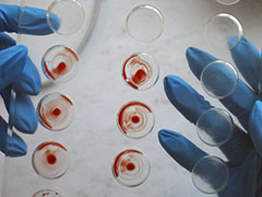 Общий анализ крови при онкологии