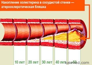 Ateroskleroticheskaya-blyashka