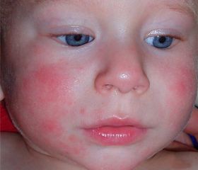  Атопический дерматит у детей 