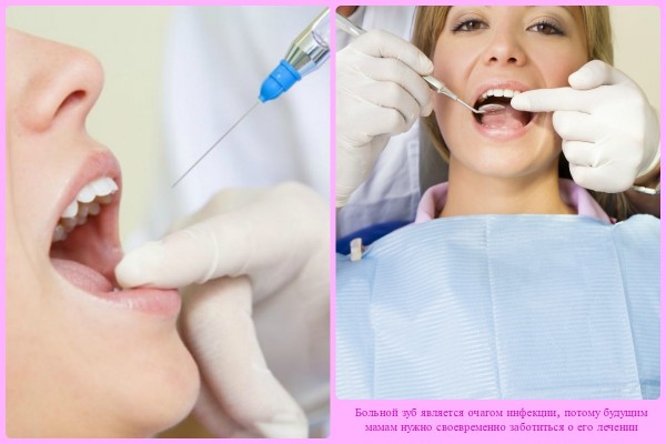 Больной зуб является очагом инфекции, потому будущим мамам нужно своевременно заботиться о его лечении