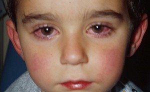 Глазные инфекции у детей2